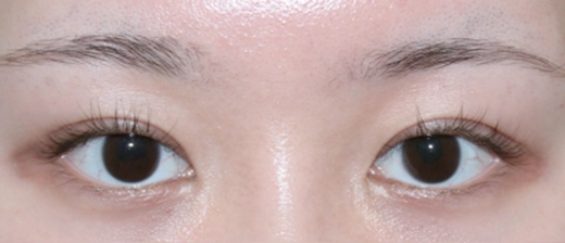비절개 눈매교정 after