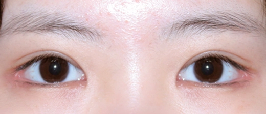 기린 눈매교정 after