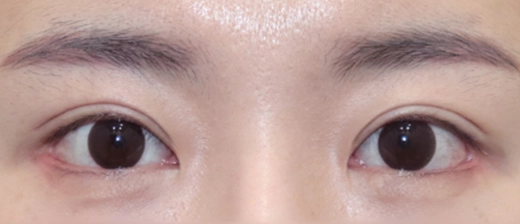 기린 눈매교정 after