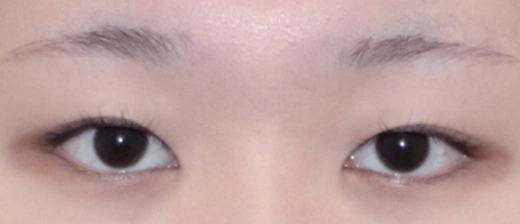 기린 눈매교정 before