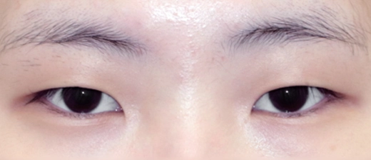 기린 눈매교정 before