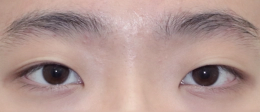 기린 눈매교정 before