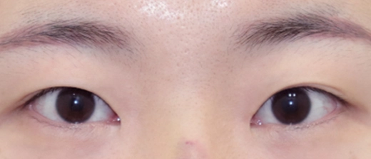 기린 눈매교정 before