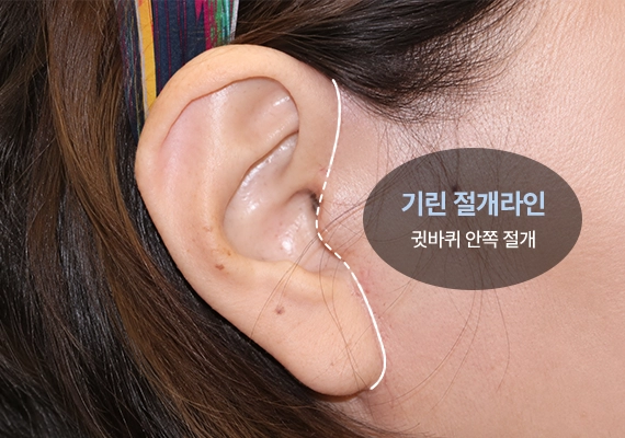 기린 절개라인 : 귓바퀴 안쪽 절개