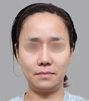 기린 노스카 안면거상 수술 전