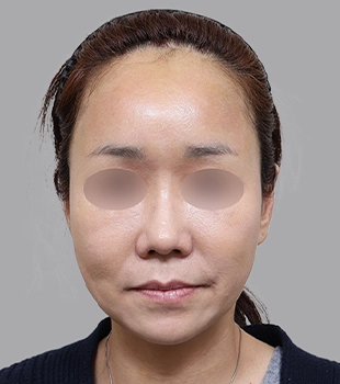 기린 노스카 안면거상 수술 후