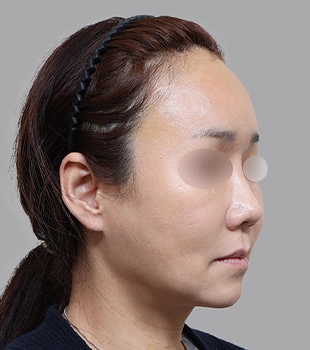 기린 노스카 안면거상 수술 후