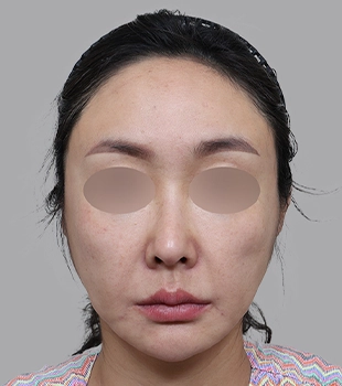 기린 노스카 안면거상 수술 전