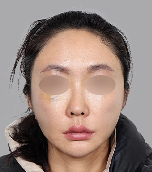 기린 노스카 안면거상 수술 후
