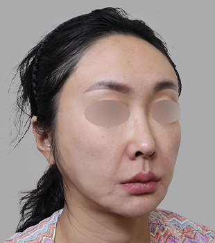 기린 노스카 안면거상 수술 전