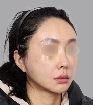 기린 노스카 안면거상 수술 후