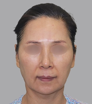 기린 노스카 안면거상 수술 전