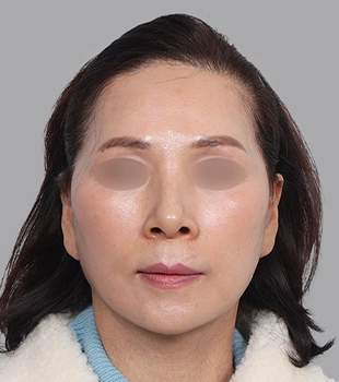 기린 노스카 안면거상 수술 후