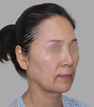 기린 노스카 안면거상 수술 전