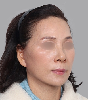 기린 노스카 안면거상 수술 후