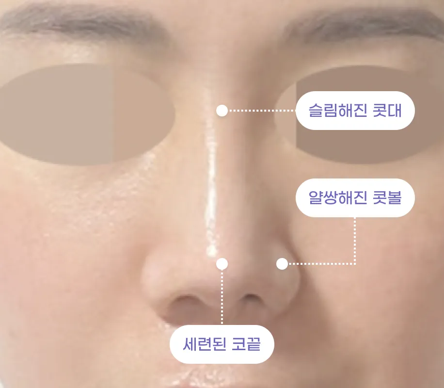 슬림해진 콧대 / 얄쌍해진 콧볼 / 세련된 코끝