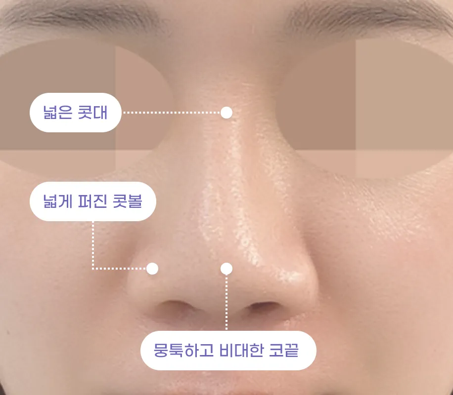 낮은 콧대 / 넓게 퍼진 콧볼 / 뭉툭하고 비대한 코끝