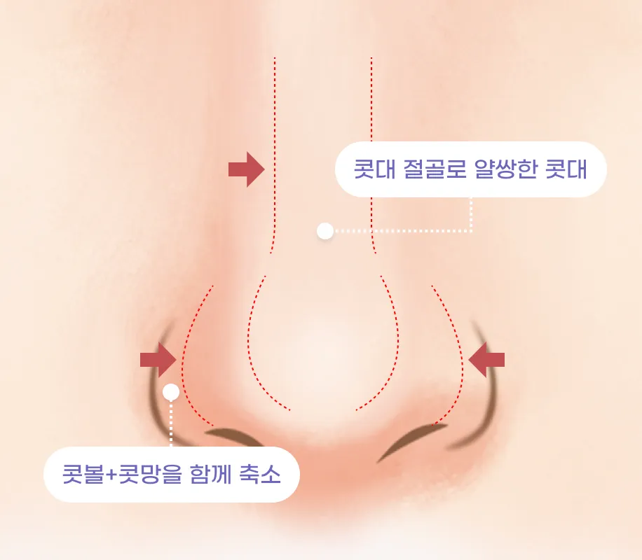 콧대 절골로 얄쌍한 콧대 / 콧볼+콧망울 함께 축소