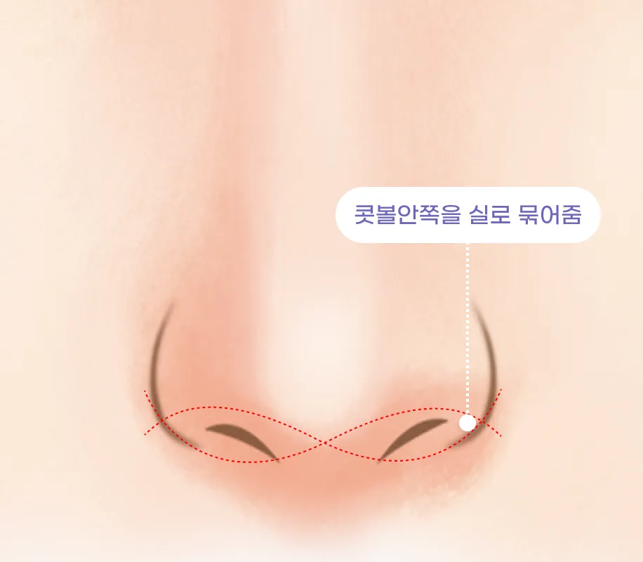 콧볼안쪽을 실로 묶어줌