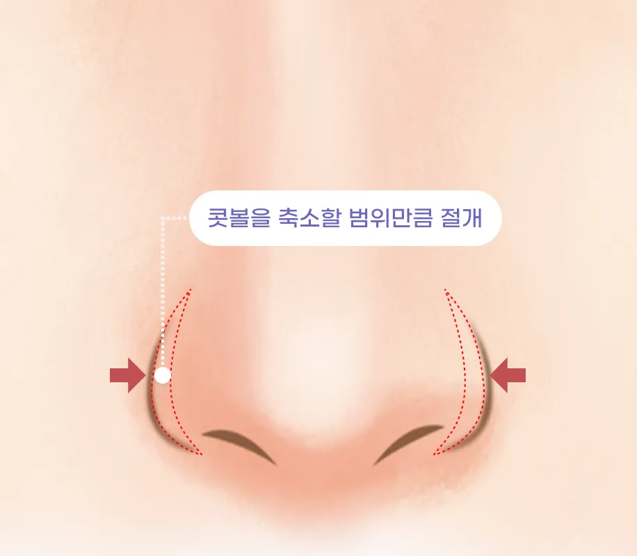 콧볼을 축소할 범위만큼 절개